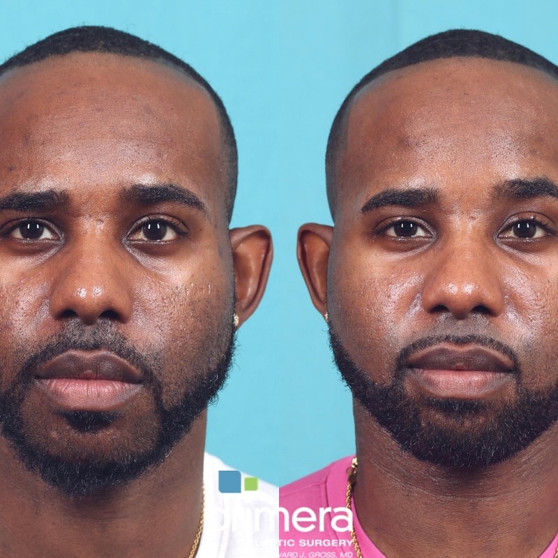 Buccal Fat Removal Before and After: What You Need to Know 29 Buccal Fat Removal Before and After: What You Need to Know