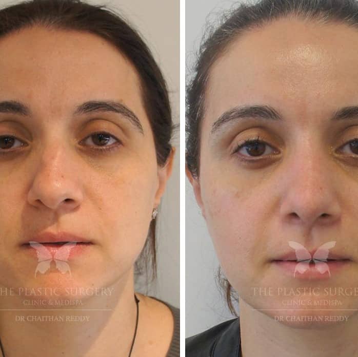 Nose Job Before and After: Dramatic Transformations and What to Expect