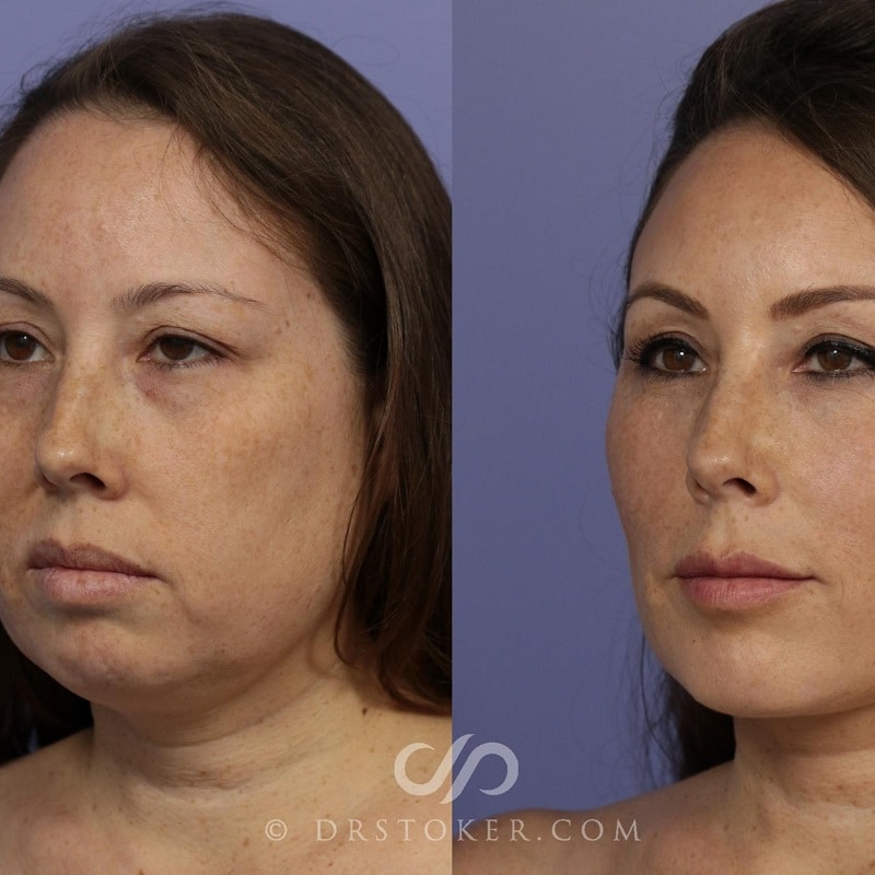 Under Eye Filler Before and After: Results and Expectations 29 Under Eye Filler Before and After: Results and Expectations