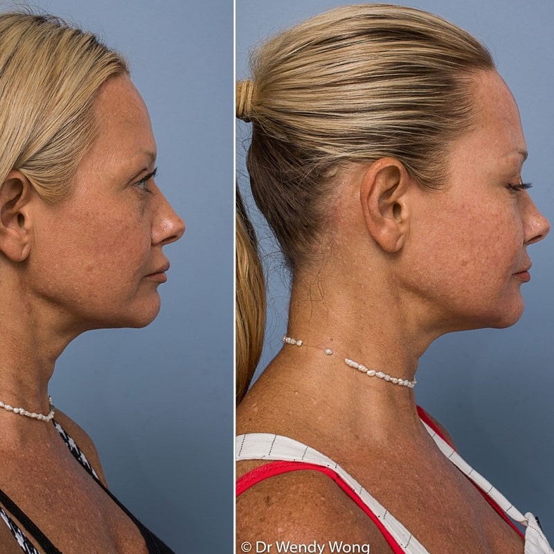 Cheek Filler Before and After: Transforming Your Appearance with Subtle Enhancements 30 Cheek Filler Before and After: Transforming Your Appearance with Subtle Enhancements