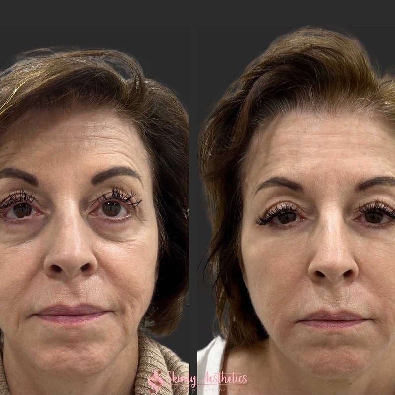 Under Eye Filler Before and After: Results and Expectations