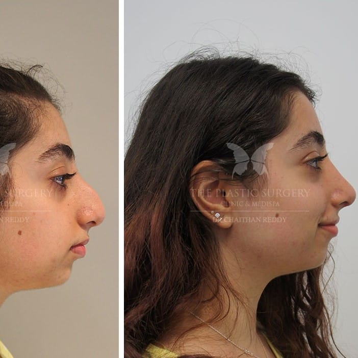 Nose Job Before and After: Dramatic Transformations and What to Expect