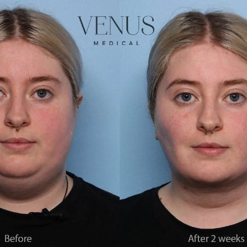 Buccal Fat Removal Before and After: What You Need to Know 31 Buccal Fat Removal Before and After: What You Need to Know