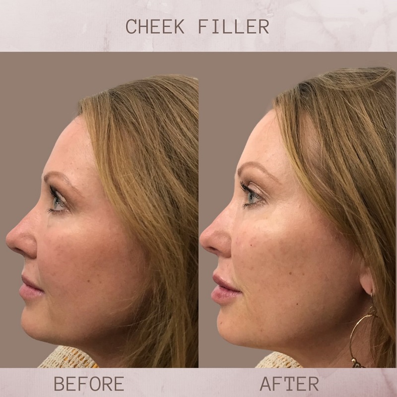 Cheek Filler Before and After: Transforming Your Appearance with Subtle Enhancements 31 Cheek Filler Before and After: Transforming Your Appearance with Subtle Enhancements
