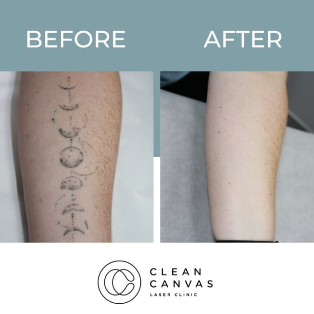 Tattoo Removal Before and After: What You Need to Know