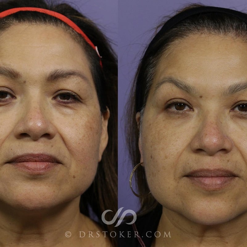 Under Eye Filler Before and After: Results and Expectations 30 Under Eye Filler Before and After: Results and Expectations