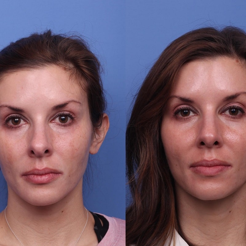 Nose Job Before and After: Dramatic Transformations and What to Expect