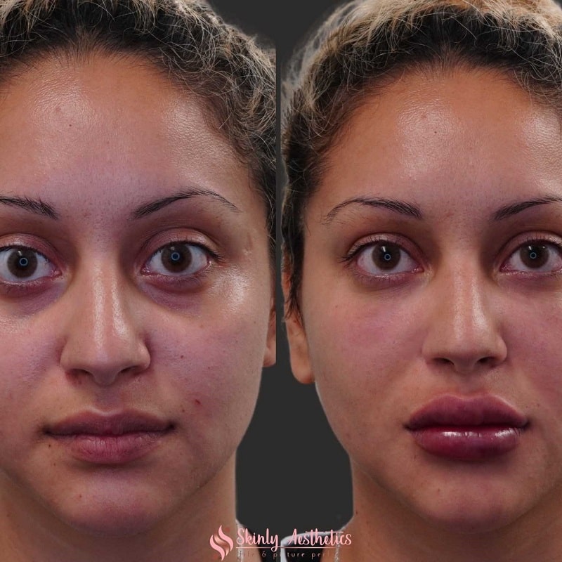 Under Eye Filler Before and After: Results and Expectations 4 Under Eye Filler Before and After: Results and Expectations