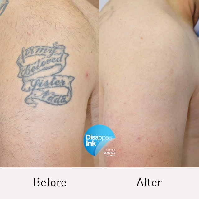 Tattoo Removal Before and After: What You Need to Know