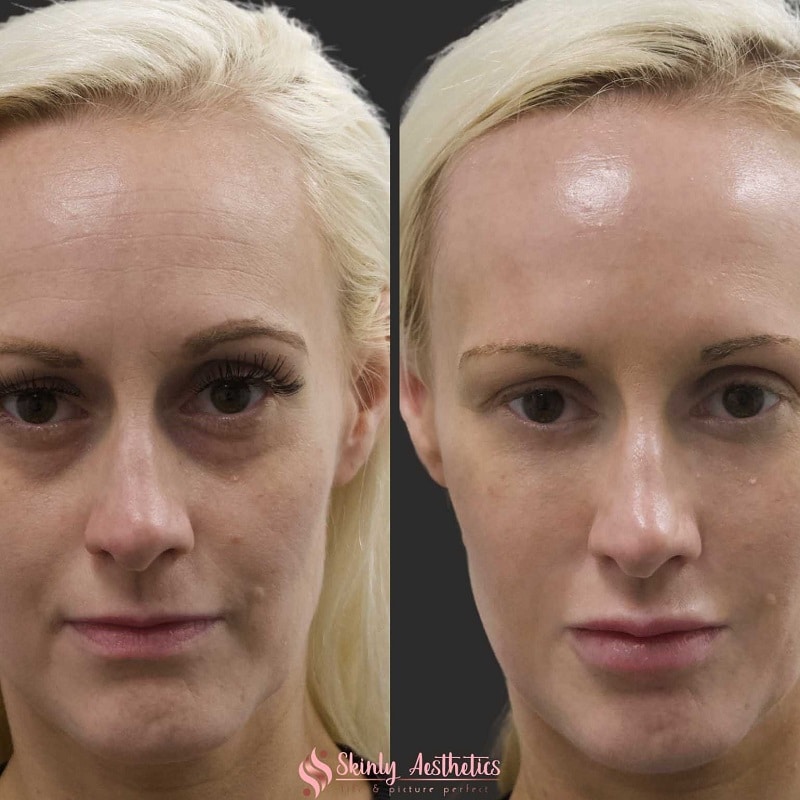 Under Eye Filler Before and After: Results and Expectations 5 Under Eye Filler Before and After: Results and Expectations