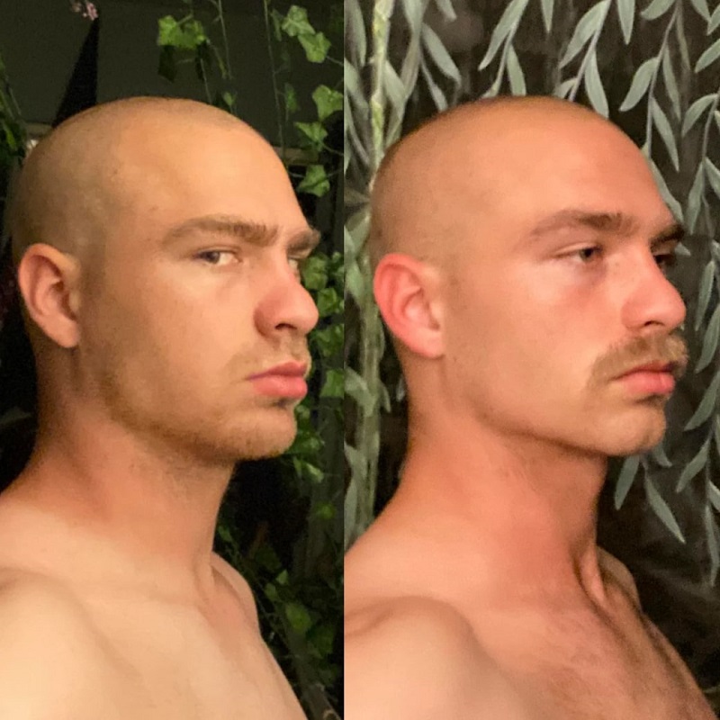 Mewing Before and After: Transforming Your Face with Proper Tongue Posture