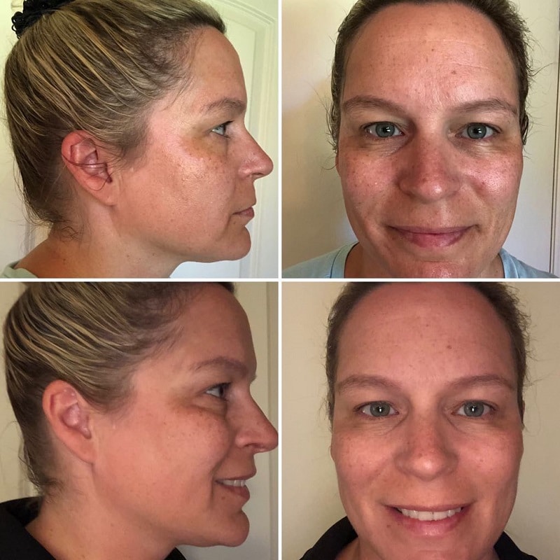 Modere Collagen Before and After: Real Results Revealed 6 Modere Collagen Before and After: Real Results Revealed