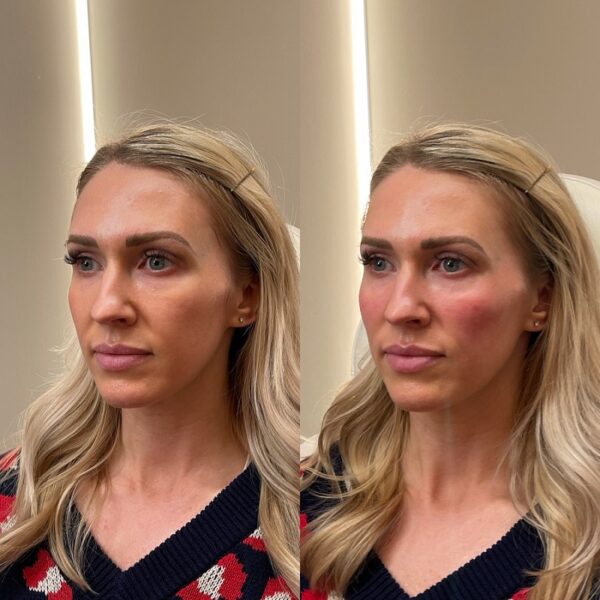 Cheek Filler Before and After Transforming Your Appearance with Subtle Enhancements Must Read