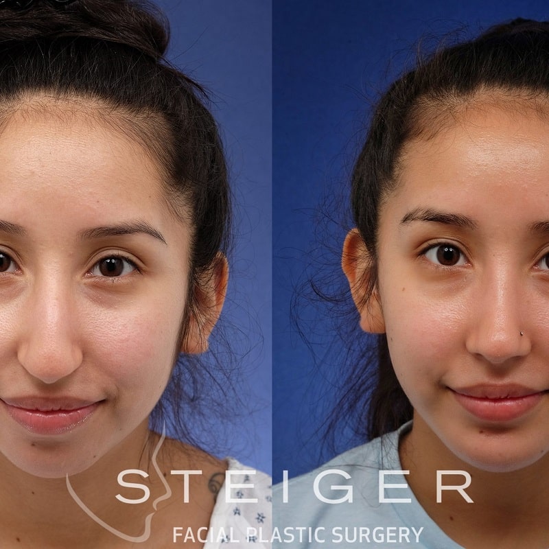 Nose Job Before and After: Dramatic Transformations and What to Expect