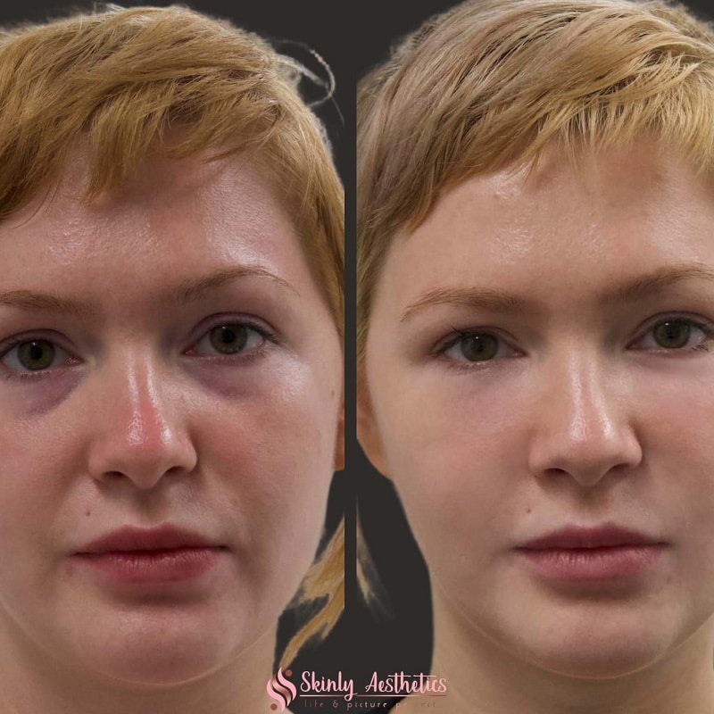 Under Eye Filler Before and After: Results and Expectations