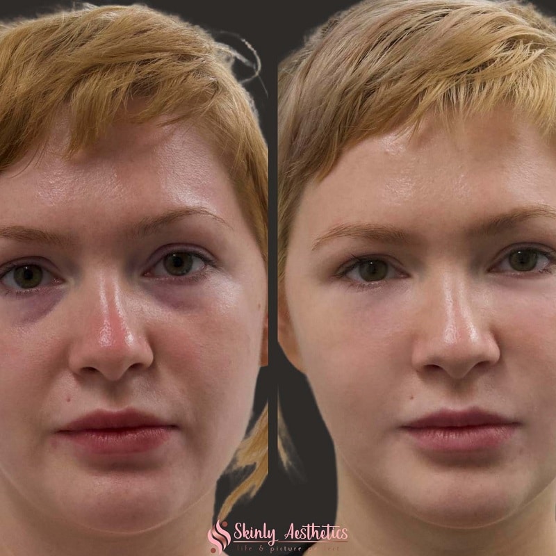 Under Eye Filler Before and After: Results and Expectations 6 Under Eye Filler Before and After: Results and Expectations