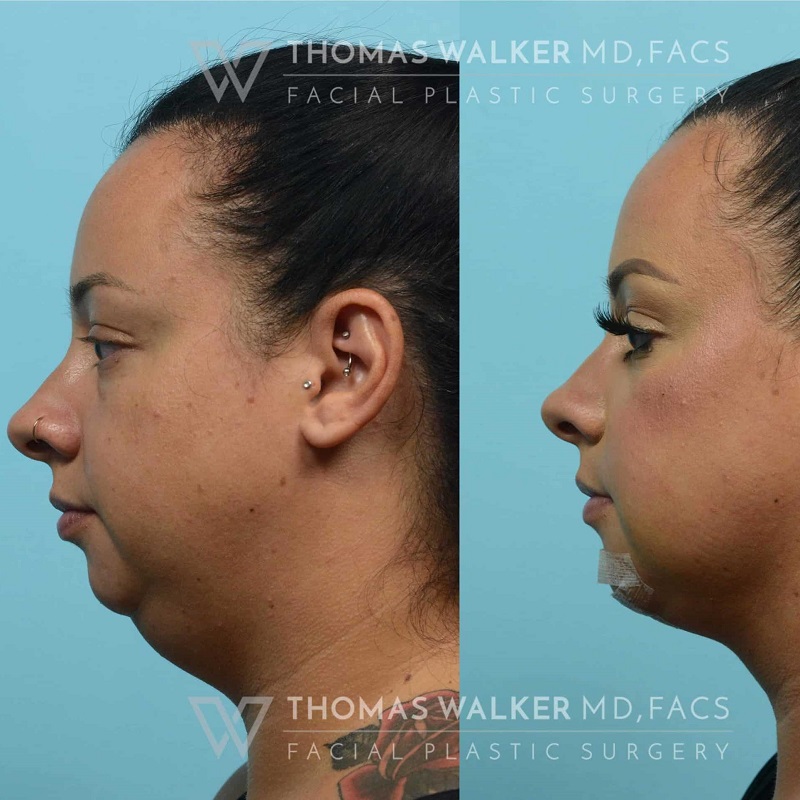 Buccal Fat Removal Before and After: What You Need to Know