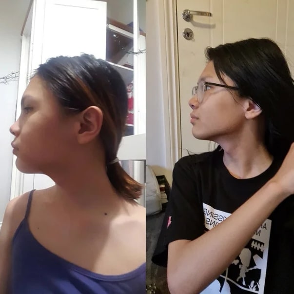 Mewing Before and After: Transforming Your Face with Proper Tongue Posture