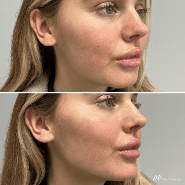 Cheek Filler Before and After: Transforming Your Appearance with Subtle Enhancements