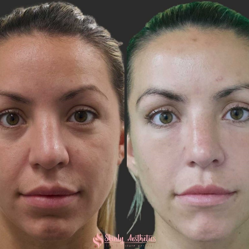 Under Eye Filler Before and After: Results and Expectations 7 Under Eye Filler Before and After: Results and Expectations