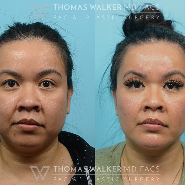Buccal Fat Removal Before and After: What You Need to Know 8 Buccal Fat Removal Before and After: What You Need to Know