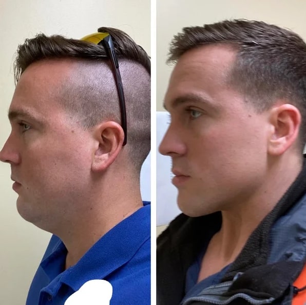 Mewing Before and After: Transforming Your Face with Proper Tongue Posture 8 Mewing Before and After: Transforming Your Face with Proper Tongue Posture