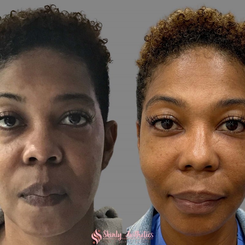 Under Eye Filler Before and After: Results and Expectations 8 Under Eye Filler Before and After: Results and Expectations