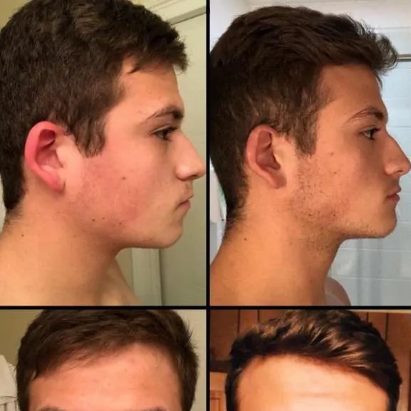 Mewing Before and After: Transforming Your Face with Proper Tongue Posture