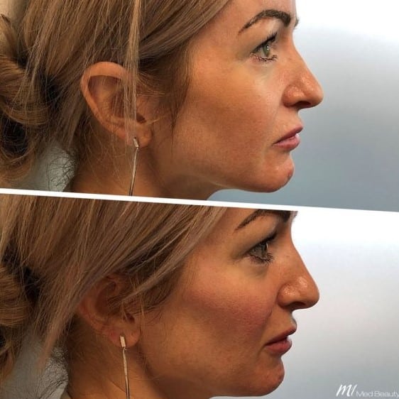 Cheek Filler Before and After: Transforming Your Appearance with Subtle Enhancements 9 Cheek Filler Before and After: Transforming Your Appearance with Subtle Enhancements