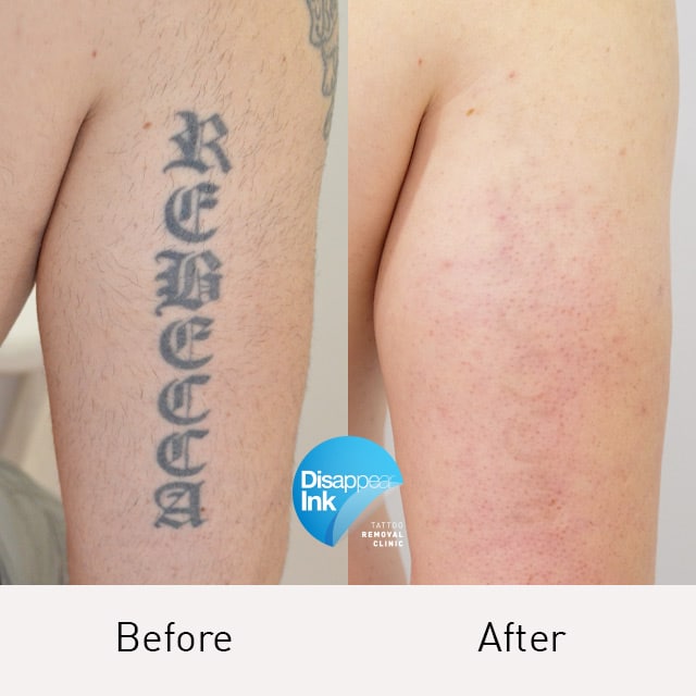 Tattoo Removal Before and After: What You Need to Know