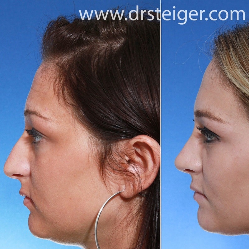 Nose Job Before and After: Dramatic Transformations and What to Expect