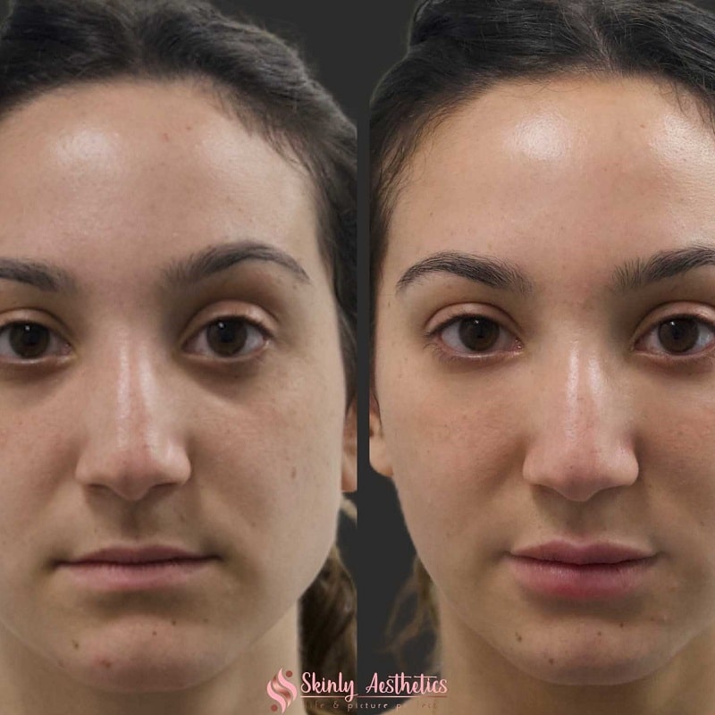 Under Eye Filler Before and After: Results and Expectations 9 Under Eye Filler Before and After: Results and Expectations