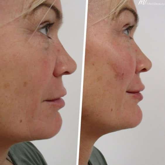 Cheek Filler Before and After: Transforming Your Appearance with Subtle Enhancements 10 Cheek Filler Before and After: Transforming Your Appearance with Subtle Enhancements
