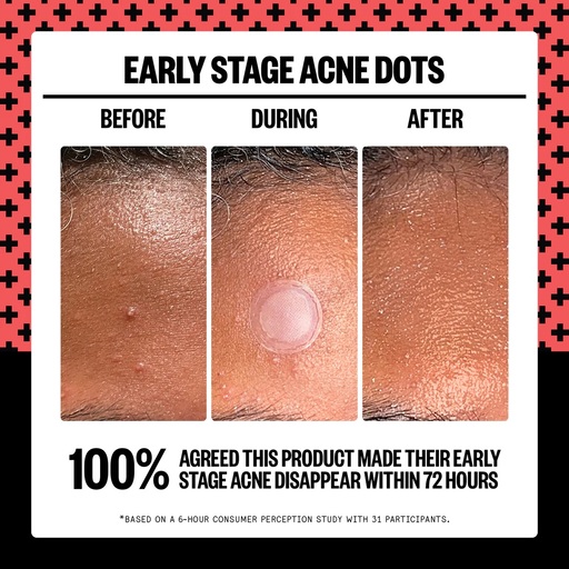 Peace Out Skincare Early-Stage Acne Dots Review